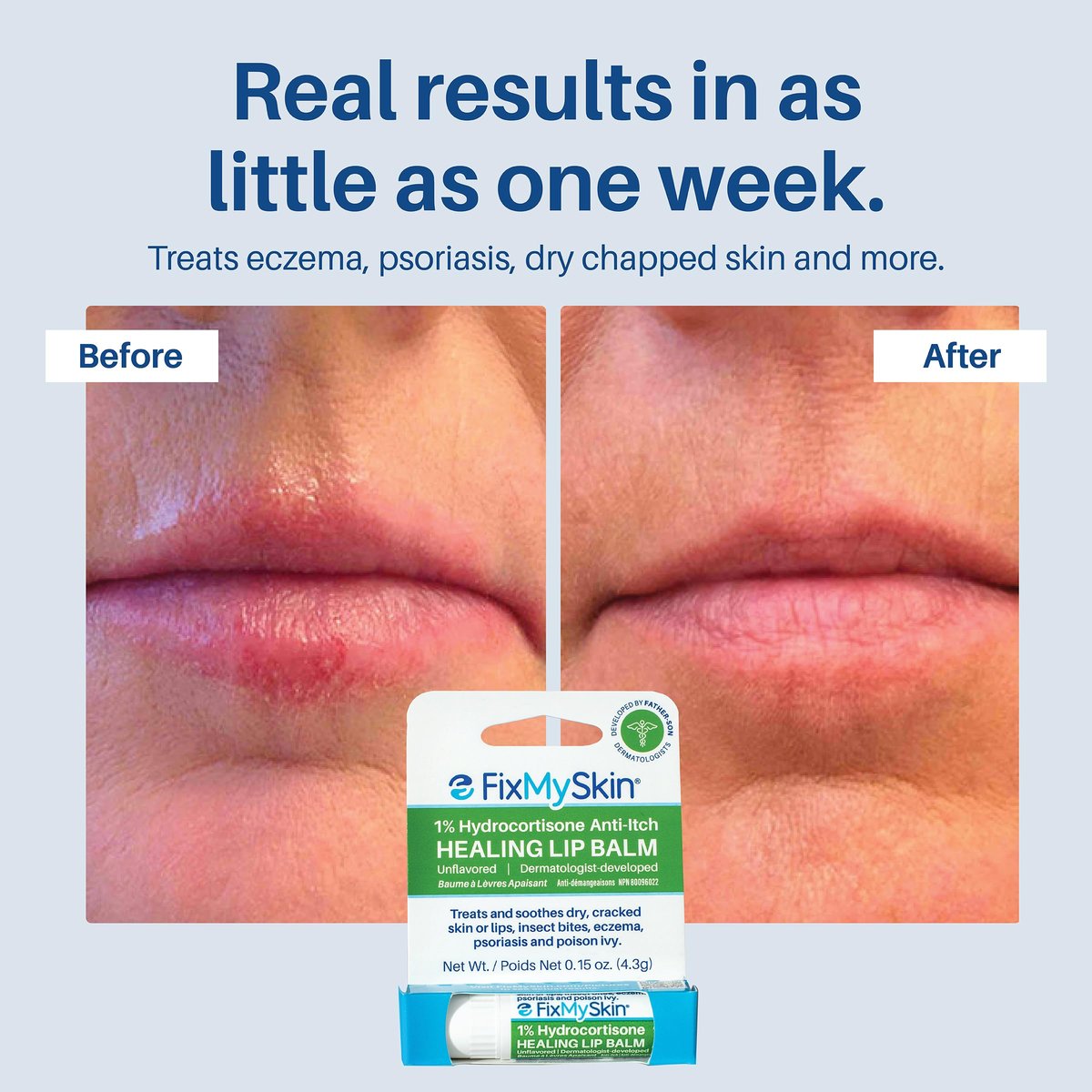 FixMySkin 1% Hydrocortisone Healing Lip Balm – Soothes Dry, Cracked & Irritated Lips, Unflavored, 0.15 oz Travel Tube - görsel 9