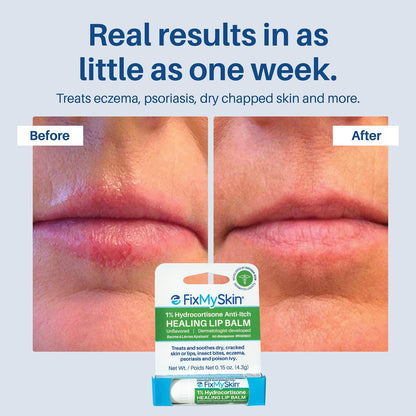 FixMySkin 1% Hydrocortisone Healing Lip Balm – Soothes Dry, Cracked & Irritated Lips, Unflavored, 0.15 oz Travel Tube
