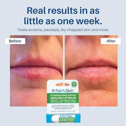 FixMySkin 1% Hydrocortisone Healing Lip Balm – Soothes Dry, Cracked & Irritated Lips, Unflavored, 0.15 oz Travel Tube