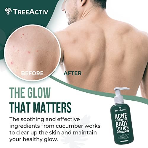 TreeActiv Acne Eliminating Body Lotion - Cucumber Mint Scent, 8 fl oz - Clears Body, Back, Butt and Shoulder Acne - Anti-Acne Moisturizer - Prevents Future Breakouts Avelisse
