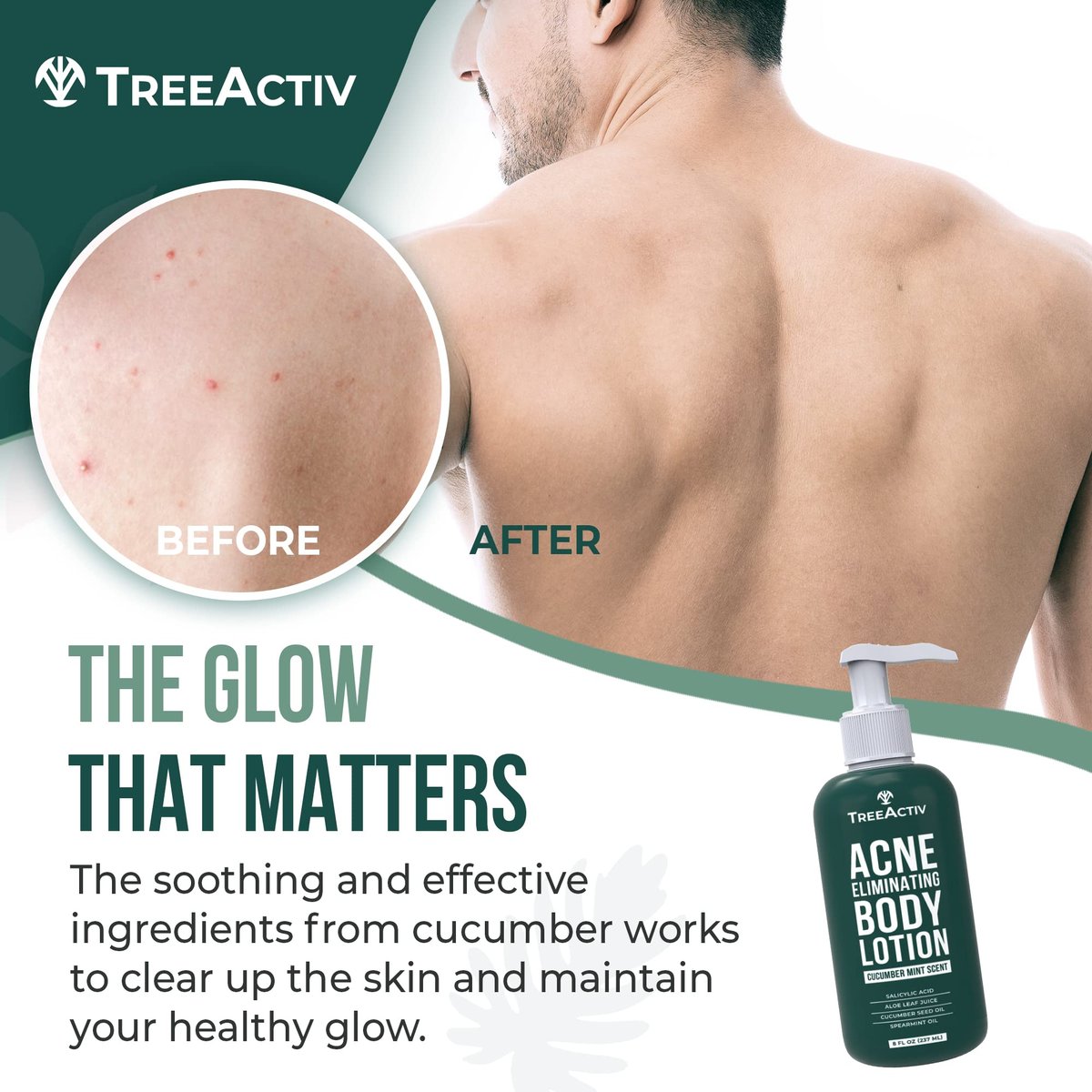 TreeActiv Acne Eliminating Body Lotion - Cucumber Mint Scent, 8 fl oz - Clears Body, Back, Butt and Shoulder Acne - Anti-Acne Moisturizer - Prevents Future Breakouts Avelisse