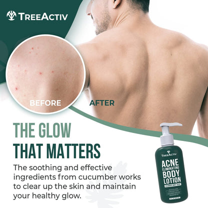 TreeActiv Acne Eliminating Body Lotion - Cucumber Mint Scent, 8 fl oz - Clears Body, Back, Butt and Shoulder Acne - Anti-Acne Moisturizer - Prevents Future Breakouts Avelisse