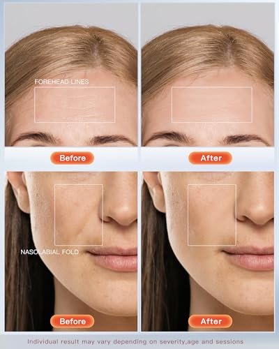 NEWKEY 4D LED Red & Blue Light Therapy Face Mask – Anti-Aging & Acne Treatment with 150 LEDs, 10-Minute Auto-Off, Plug-In Avelisse
