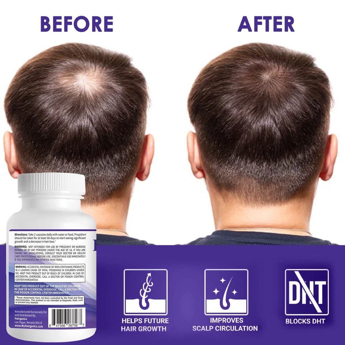Propidren by HairGenics - DHT Blocker & Hair Growth Capsules | Natural Hair Regrowth Treatment for Men & Women Avelisse