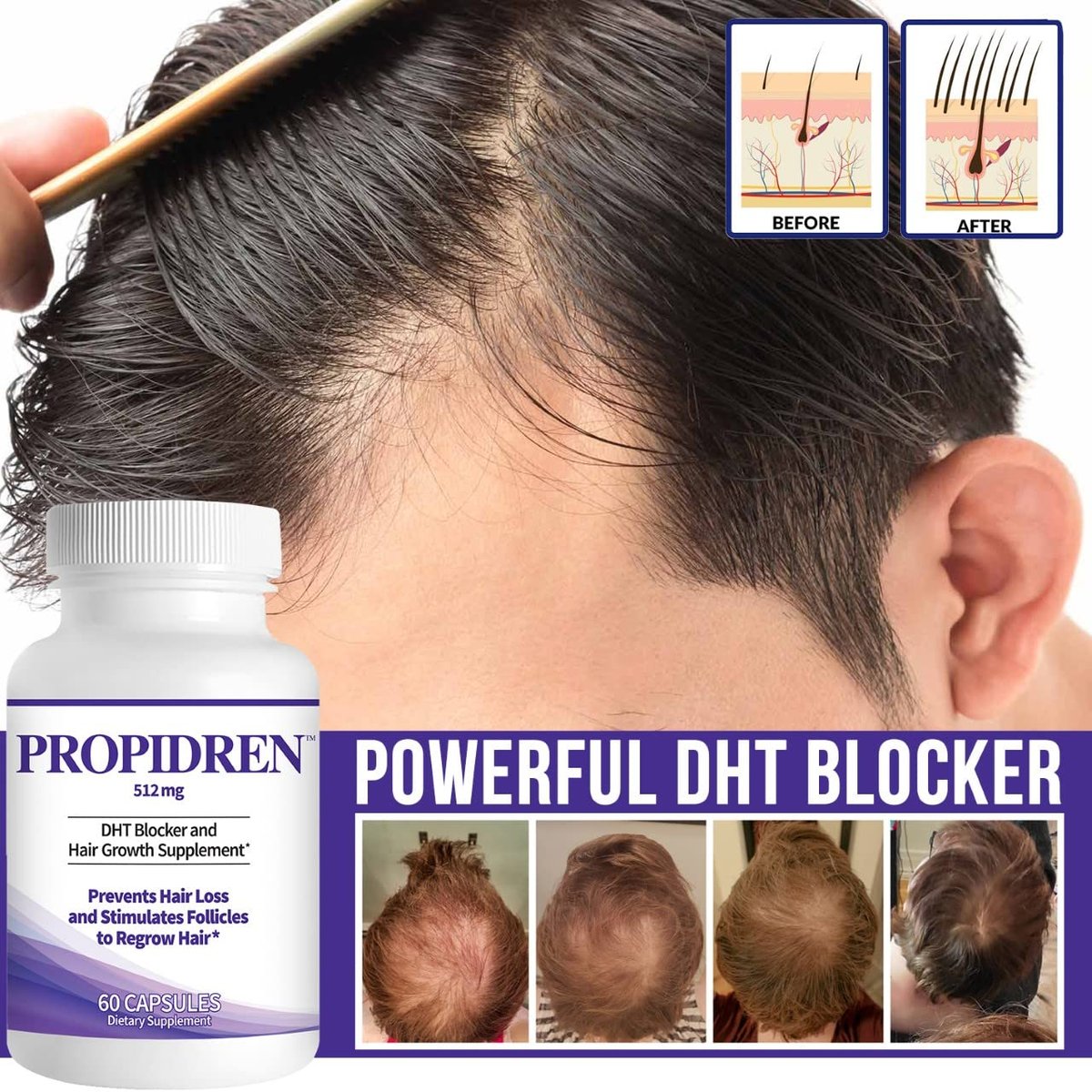 Propidren by HairGenics - DHT Blocker & Hair Growth Capsules | Natural Hair Regrowth Treatment for Men & Women Avelisse