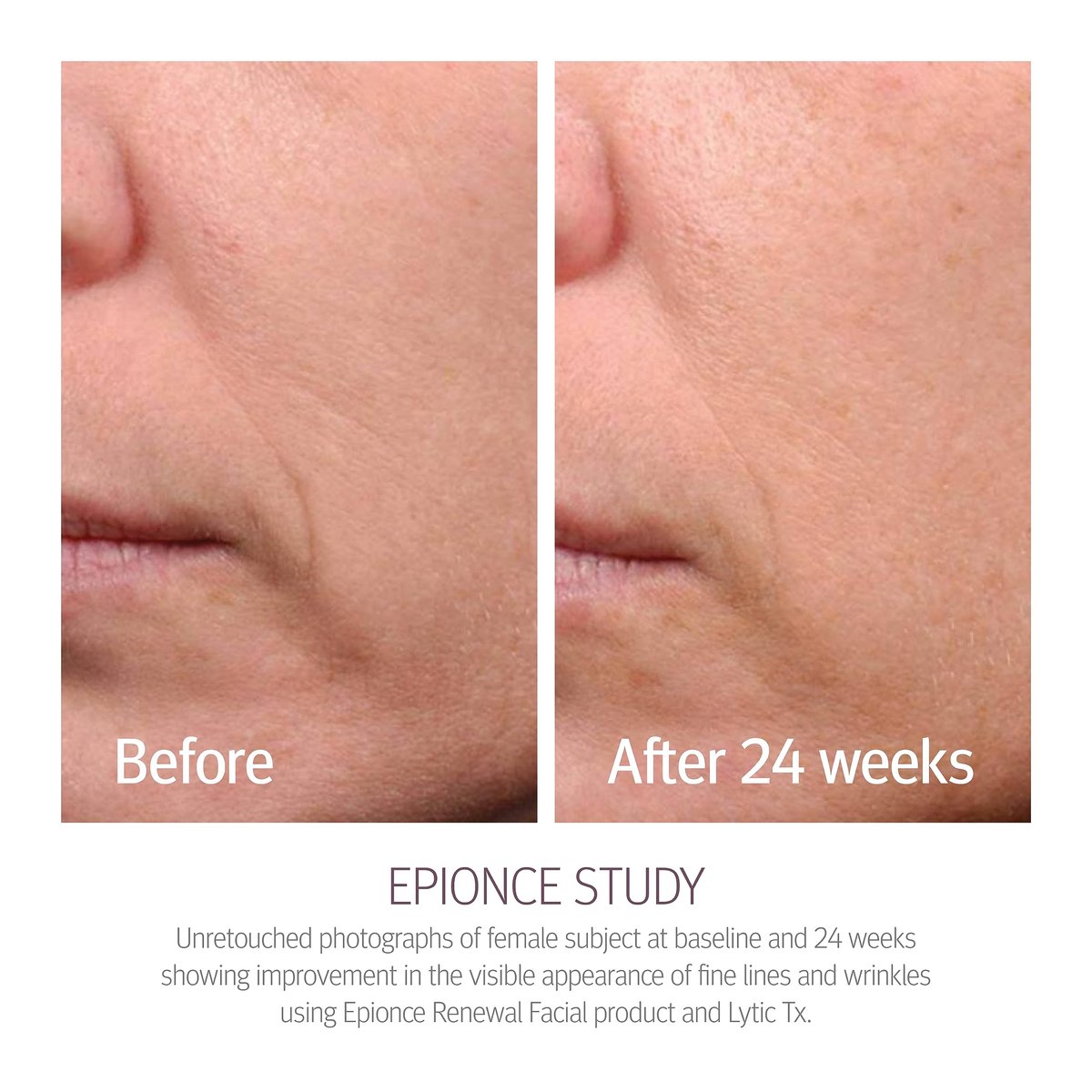 Epionce Renewal Facial Lotion – Hydrating Anti-Aging Moisturizer for Normal to Combination Skin, Reduces Fine Lines & Wrinkles, Dermatologist-Developed Skincare Avelisse