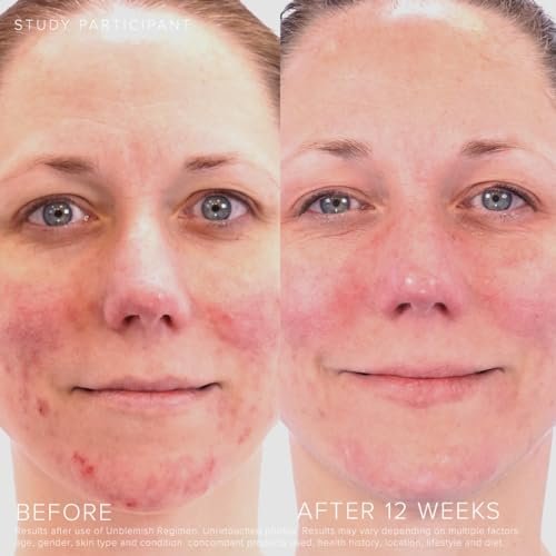 Rodan + Fields Unblemish Dual Intensive Acne Treatment – Benzoyl Peroxide & Ceramides, 0.76 Fl Oz Avelisse