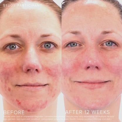 Rodan + Fields Unblemish Dual Intensive Acne Treatment – Benzoyl Peroxide & Ceramides, 0.76 Fl Oz Avelisse