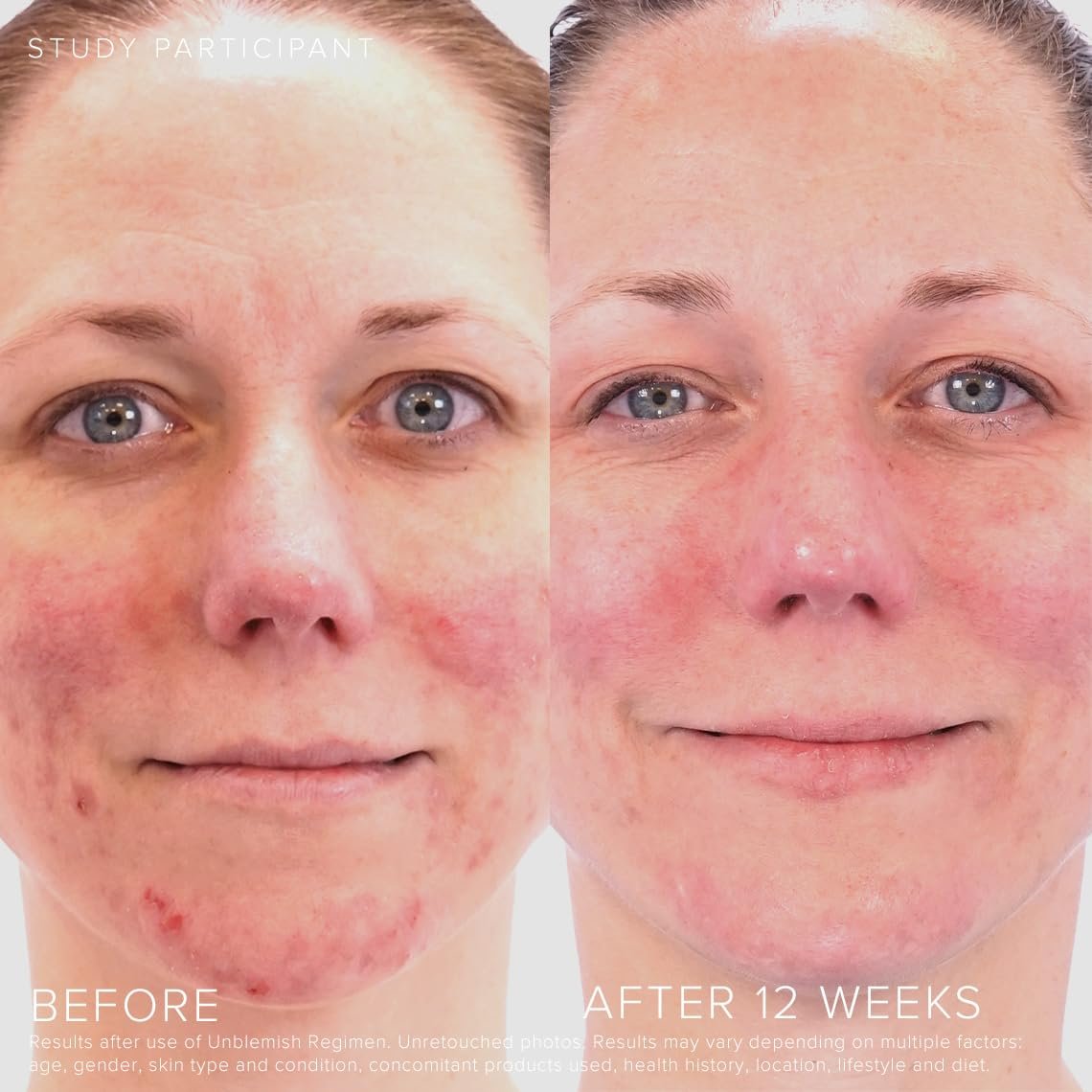 Rodan + Fields Unblemish Dual Intensive Acne Treatment – Benzoyl Peroxide & Ceramides, 0.76 Fl Oz Avelisse
