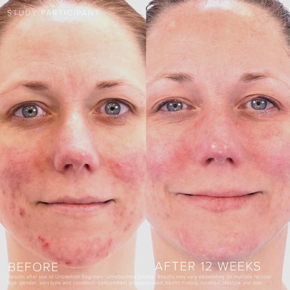 Rodan + Fields Unblemish Dual Intensive Acne Treatment – Benzoyl Peroxide & Ceramides, 0.76 Fl Oz Avelisse