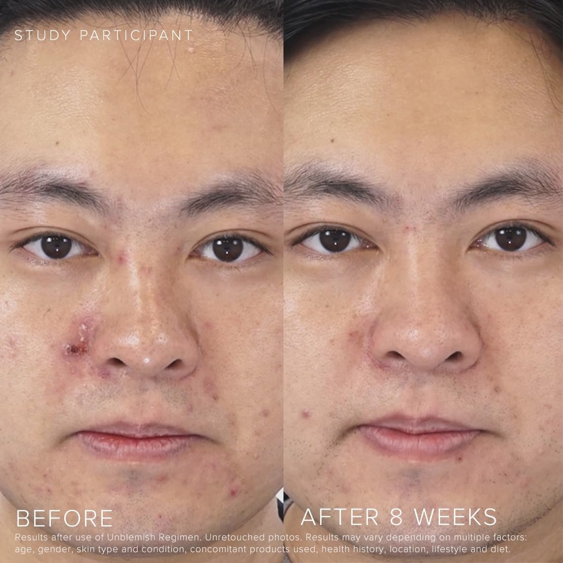 Rodan + Fields Unblemish Dual Intensive Acne Treatment – Benzoyl Peroxide & Ceramides, 0.76 Fl Oz Avelisse