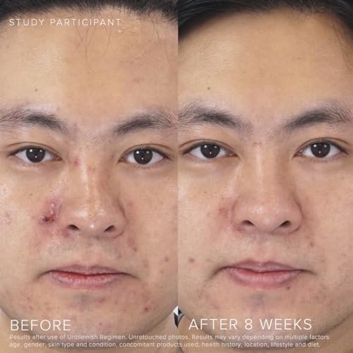 Rodan + Fields Unblemish Dual Intensive Acne Treatment – Benzoyl Peroxide & Ceramides, 0.76 Fl Oz Avelisse