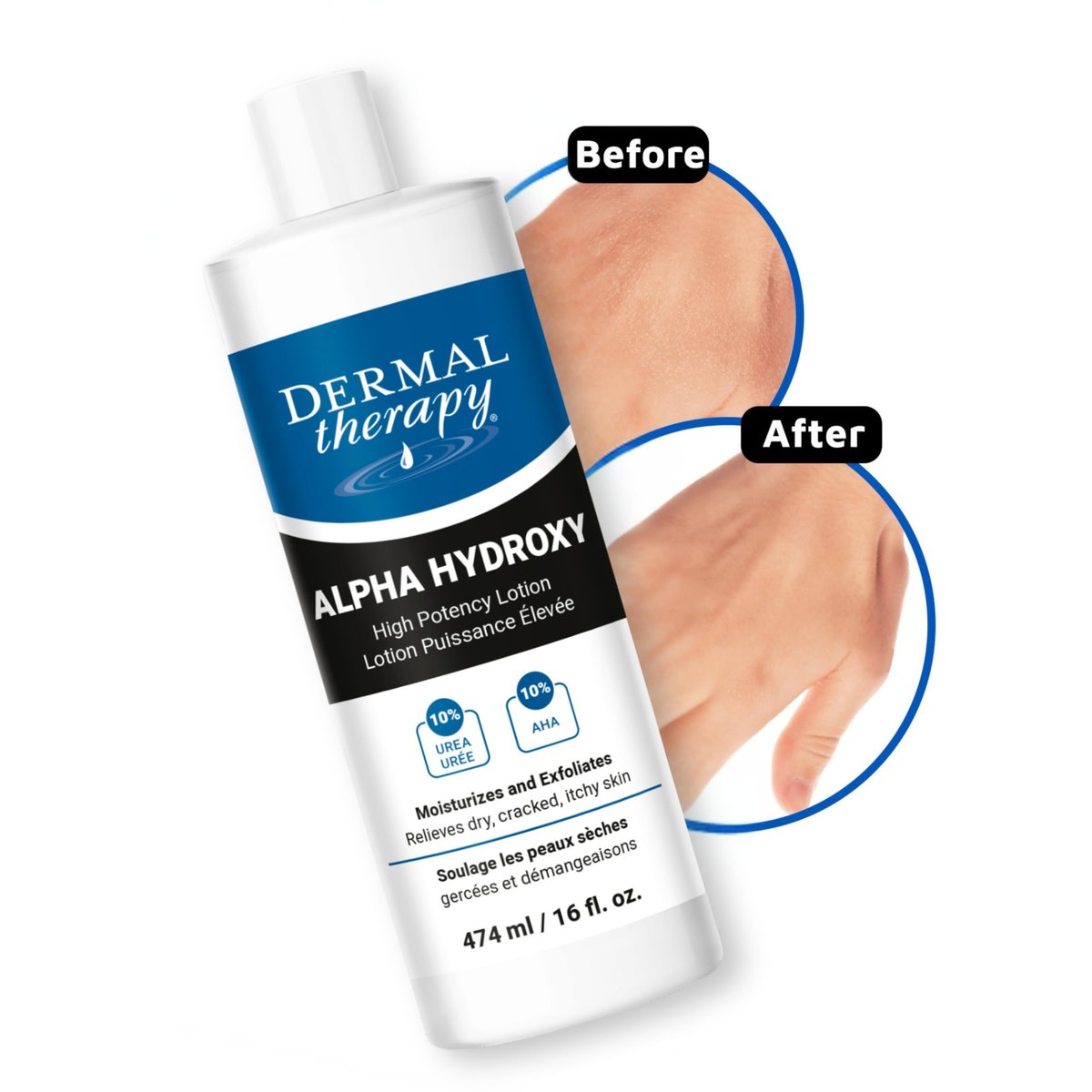 Dermal Therapy Alpha Hydroxy Lotion – 10% Urea + 10% Lactic Acid, Fragrance-Free Body Lotion for Dry, Cracked Skin, Non-Greasy Exfoliating Moisturizer & Keratosis Pilaris Treatment, 16 fl oz (474 ml) Avelisse