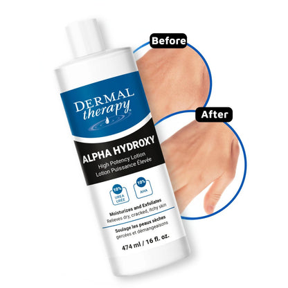 Dermal Therapy Alpha Hydroxy Lotion – 10% Urea + 10% Lactic Acid, Fragrance-Free Body Lotion for Dry, Cracked Skin, Non-Greasy Exfoliating Moisturizer & Keratosis Pilaris Treatment, 16 fl oz (474 ml) Avelisse