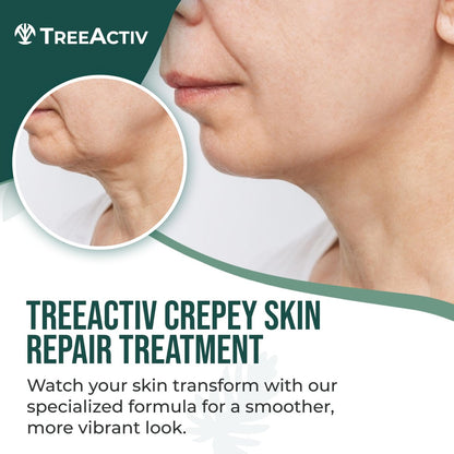 TreeActiv Crepey Skin Repair Cream – Firming Body & Neck Cream with Hyaluronic Acid, Glycolic Acid & Shea Butter, 8 oz Avelisse