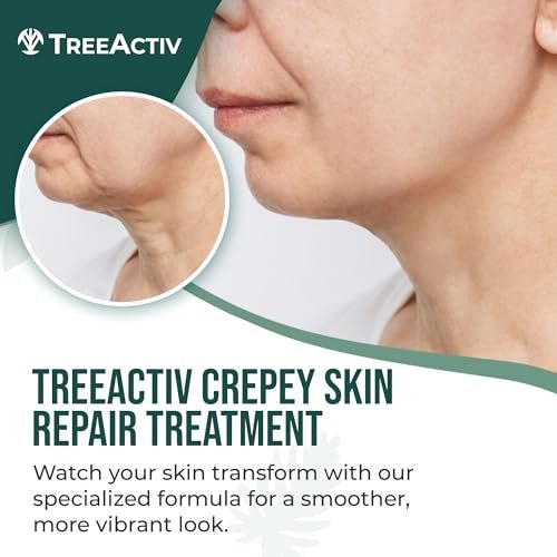 TreeActiv Crepey Skin Repair Cream – Firming Body & Neck Cream with Hyaluronic Acid, Glycolic Acid & Shea Butter, 8 oz Avelisse