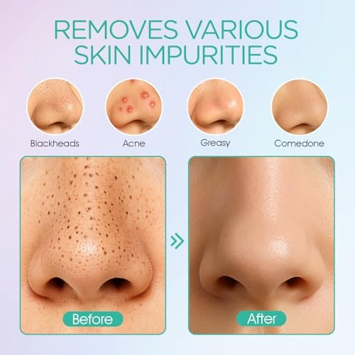 VOYOR Blackhead Remover Pore Vacuum - Electric Face Vacuum Pore Cleaner for Acne and White Heads Removal with 6 Suction Heads (BR410) Avelisse
