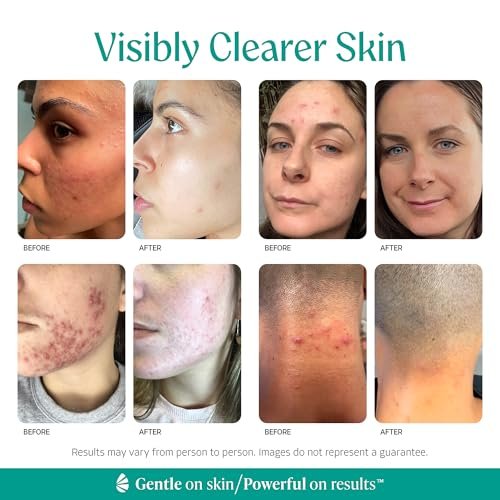 Almond Clear Face & Body Clearing Serum Level 1 – Mandelic Acid for Acne, Folliculitis, Ingrown Hairs, Dark Spots – 1 fl oz Avelisse