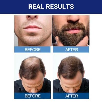 Kirkland Signature Minoxidil for Men 5% Extra Strength Hair Regrowth, 1 Month Supply