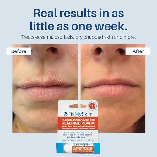 FixMySkin 1% Hydrocortisone Healing Lip Balm, Vanilla – Soothes Dry, Cracked & Irritated Lips, Relieves Chapped Lips, Cold Sores & Eczema, Dermatologist Developed, Travel-Friendly Tube, 0.15 oz Avelisse