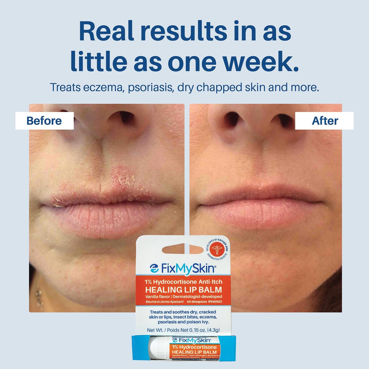 FixMySkin 1% Hydrocortisone Healing Lip Balm, Vanilla – Soothes Dry, Cracked & Irritated Lips, Relieves Chapped Lips, Cold Sores & Eczema, Dermatologist Developed, Travel-Friendly Tube, 0.15 oz Avelisse