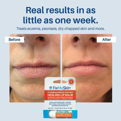 FixMySkin 1% Hydrocortisone Healing Lip Balm, Vanilla – Soothes Dry, Cracked & Irritated Lips, Relieves Chapped Lips, Cold Sores & Eczema, Dermatologist Developed, Travel-Friendly Tube, 0.15 oz Avelisse