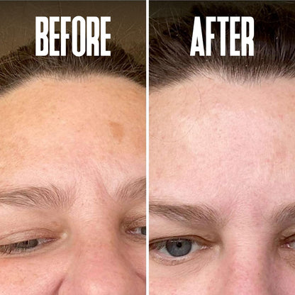 Dark Spot Corrector & Remover for Face - Stubborn Dark Spots Serum with Kojic Acid, Alpha Arbutin, Mulberry Extract - Brightening Discoloration Correcting Serum (1 Fl Oz) Avelisse