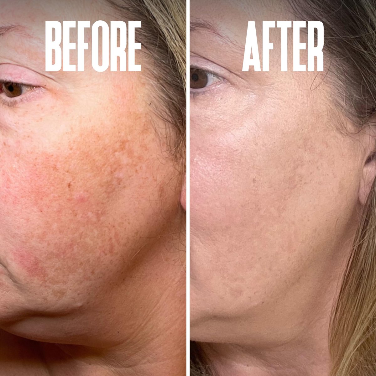 Dark Spot Corrector & Remover for Face - Stubborn Dark Spots Serum with Kojic Acid, Alpha Arbutin, Mulberry Extract - Brightening Discoloration Correcting Serum (1 Fl Oz) Avelisse