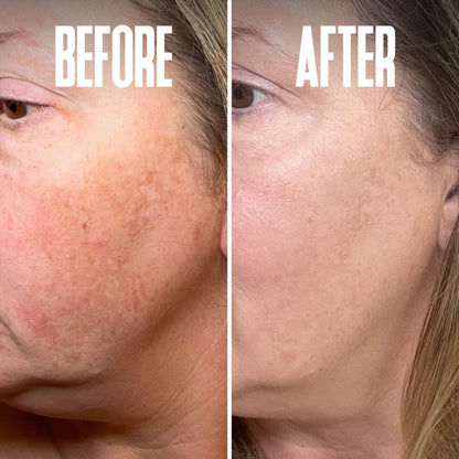 Dark Spot Corrector & Remover for Face - Stubborn Dark Spots Serum with Kojic Acid, Alpha Arbutin, Mulberry Extract - Brightening Discoloration Correcting Serum (1 Fl Oz) Avelisse