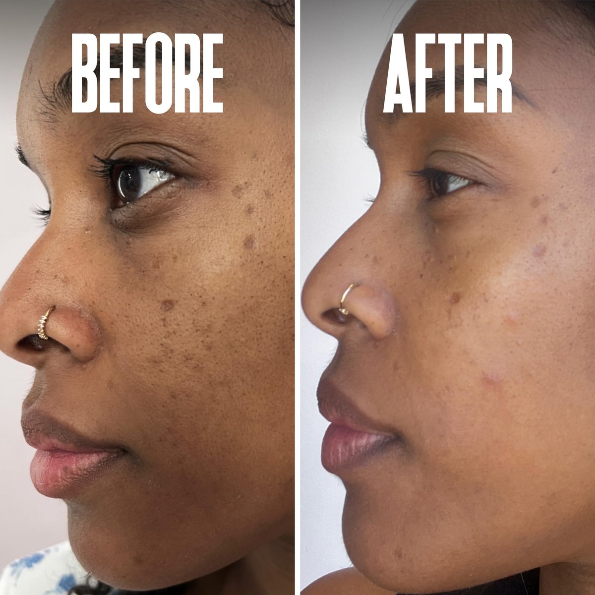 Dark Spot Corrector & Remover for Face - Stubborn Dark Spots Serum with Kojic Acid, Alpha Arbutin, Mulberry Extract - Brightening Discoloration Correcting Serum (1 Fl Oz) Avelisse