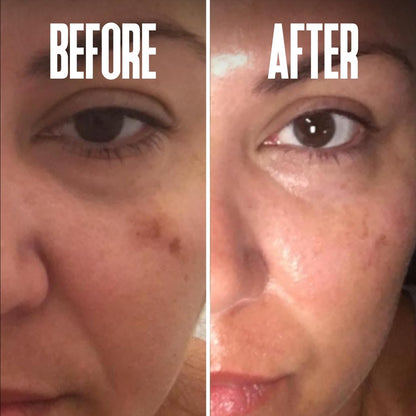 Dark Spot Corrector & Remover for Face - Stubborn Dark Spots Serum with Kojic Acid, Alpha Arbutin, Mulberry Extract - Brightening Discoloration Correcting Serum (1 Fl Oz) Avelisse