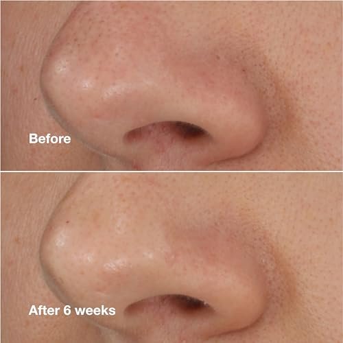 Clinique Blackhead Solutions Self-Heating Blackhead Remover with Salicylic Acid - 0.68 Fl Oz - görsel 10