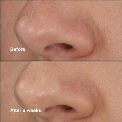 Clinique Blackhead Solutions Self-Heating Blackhead Remover with Salicylic Acid - 0.68 Fl Oz