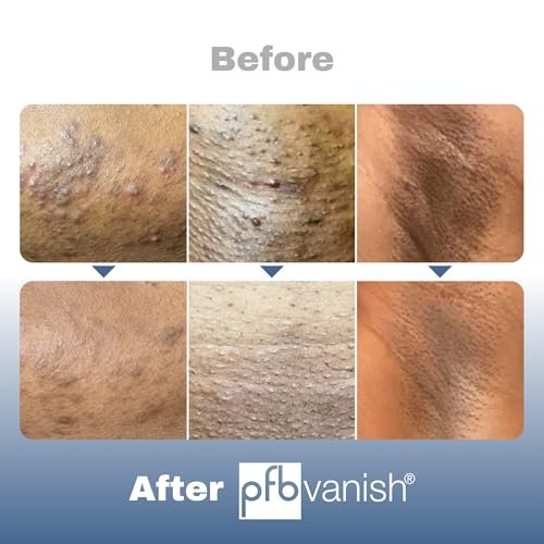 PFB Vanish Ultra Dark Spot Remover & Ingrown Hair Treatment with Chromabright & Shitake Mushroom, Roll-On, 93g Avelisse