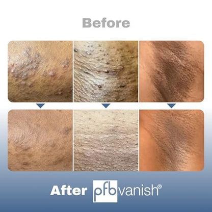 PFB Vanish Ultra Dark Spot Remover & Ingrown Hair Treatment with Chromabright & Shitake Mushroom, Roll-On, 93g Avelisse