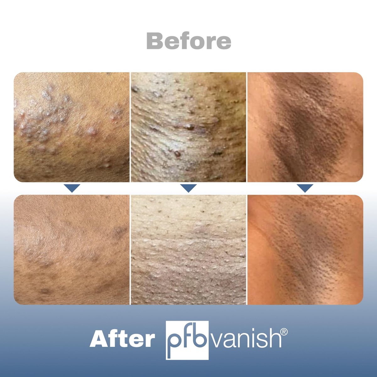 PFB Vanish Ultra Dark Spot Remover & Ingrown Hair Treatment with Chromabright & Shitake Mushroom, Roll-On, 93g Avelisse
