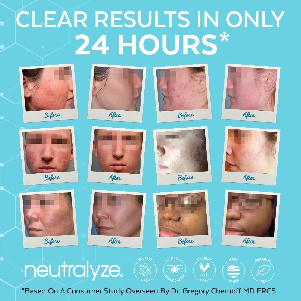 Neutralyze Renewal Complex Acne Moisturizer for Face - Maximum Strength, Time Released 2% Mandelic Acid & 2% Salicylic Acid Acne Treatment Cream - Suitable for All Skin Types, Teens & Adults Avelisse