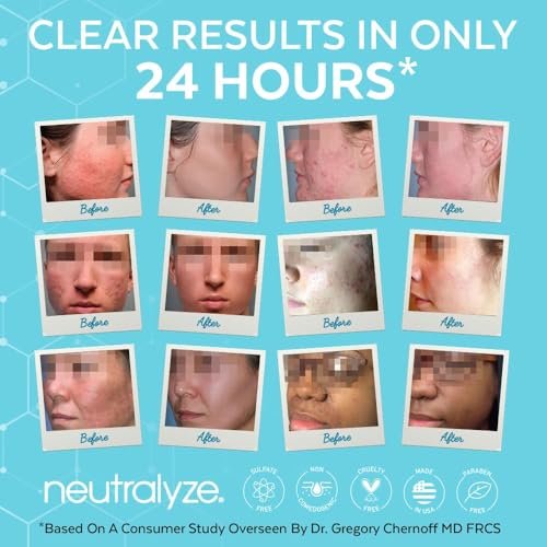 Neutralyze Renewal Complex Acne Moisturizer for Face - Maximum Strength, Time Released 2% Mandelic Acid & 2% Salicylic Acid Acne Treatment Cream - Suitable for All Skin Types, Teens & Adults Avelisse