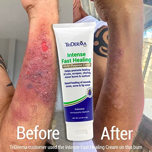 TriDerma Intense Fast Skin Healing Cream – 4 oz Tube for Hard-to-Heal Skin Irritations, Sores, Rashes, Dry Cracked Hands, Cuts, Chafing, Burns, Scrapes – FSA Eligible First Aid Essential Avelisse