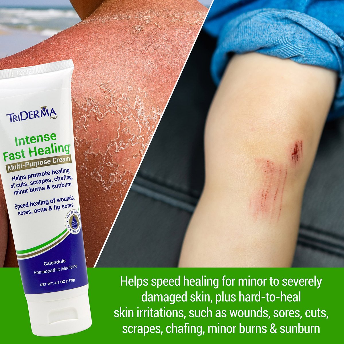 TriDerma Intense Fast Skin Healing Cream – 4 oz Tube for Hard-to-Heal Skin Irritations, Sores, Rashes, Dry Cracked Hands, Cuts, Chafing, Burns, Scrapes – FSA Eligible First Aid Essential Avelisse