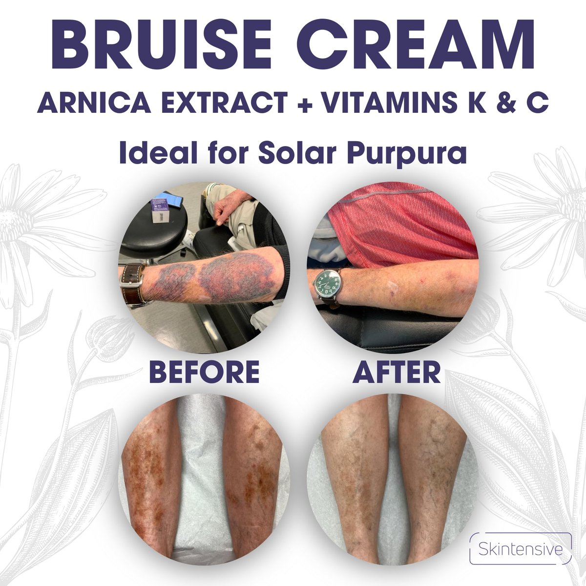 SKINTENSIVE Arnica Bruise Cream for Thin Skin - Moisturizing Arnica Cream with Vitamin K, C, and E for Skin Renewal, 4 oz - görsel 10