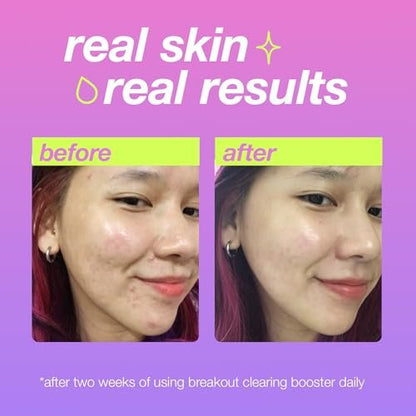 Dermalogica Clear Start Breakout Clearing Booster - Acne Spot Treatment with Salicylic Acid, 1 fl oz Avelisse
