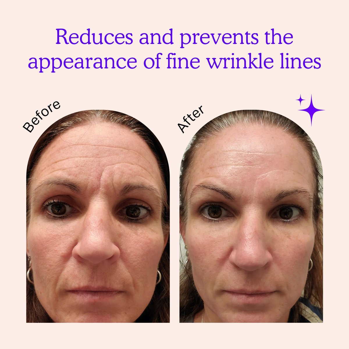 BLUMBODY Face & Forehead Wrinkle Patches – Non-Silicone Anti-Wrinkle Tape for Smoothing Eye, Mouth, Forehead Lines – 165 Count (30-Day Supply) Avelisse