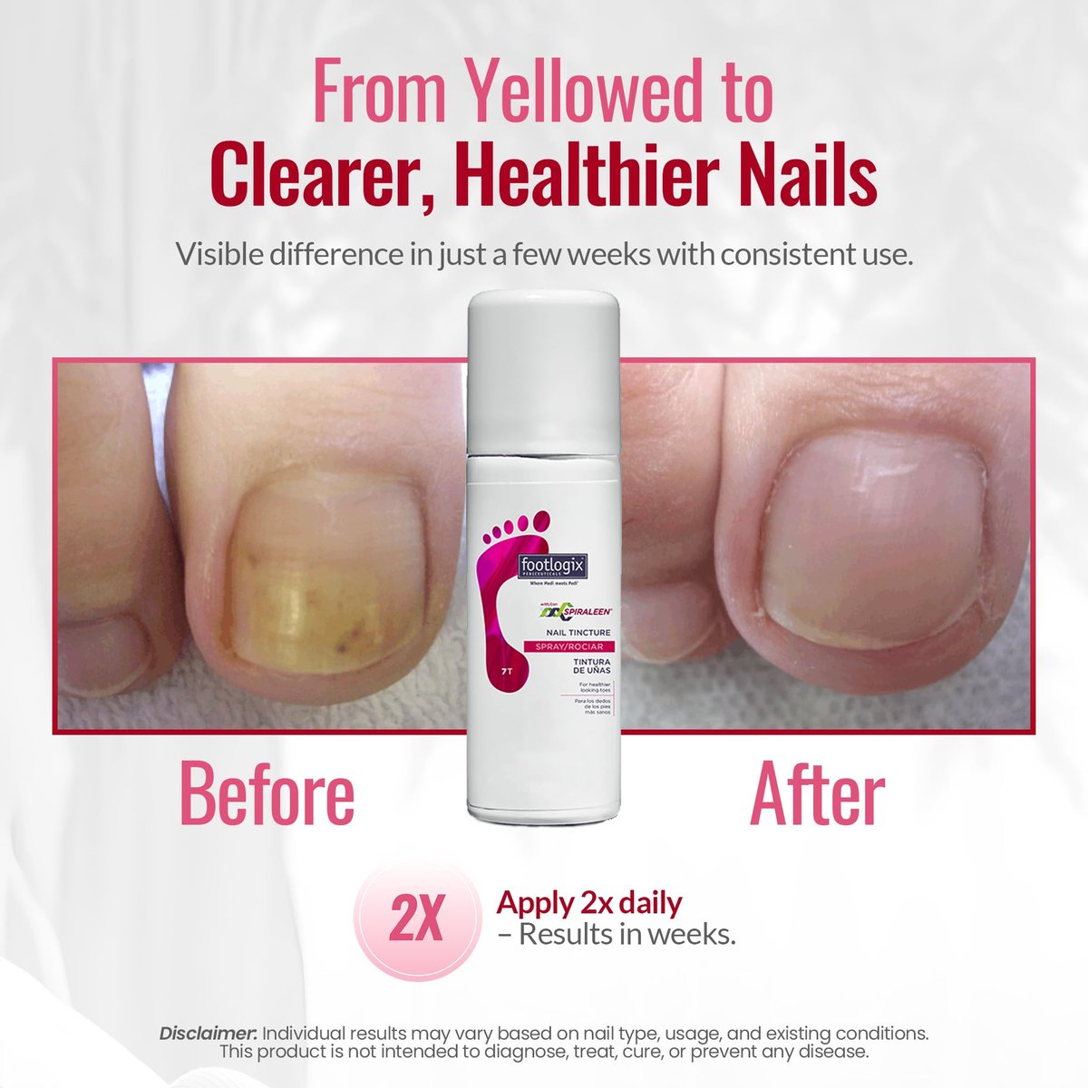 FOOTLOGIX Nail Tincture Spray with Spiraleen - 1.55 Fl Oz, Clear Nail Treatment Avelisse