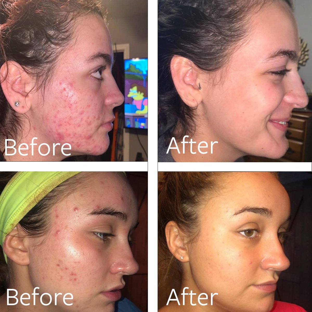 Dr Song Benzoyl Peroxide Wash 10% Acne Treatment - Acne Face Wash & Body Wash, 8 Fl Oz Avelisse