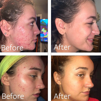 Dr Song Benzoyl Peroxide Wash 10% Acne Treatment - Acne Face Wash & Body Wash, 8 Fl Oz Avelisse