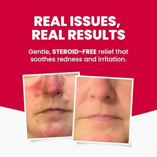 Grahams Natural Rosacea Treatment for Face Redness – Clinically Proven Anti Redness Moisturizer, Soothes & Reduces Flare Ups, Hypoallergenic & Steroid-Free (2.64 oz) Avelisse