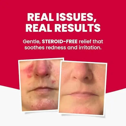 Grahams Natural Rosacea Treatment for Face Redness – Clinically Proven Anti Redness Moisturizer, Soothes & Reduces Flare Ups, Hypoallergenic & Steroid-Free (2.64 oz) Avelisse
