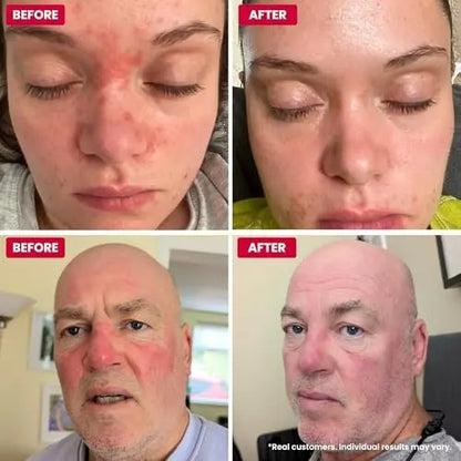 Grahams Natural Rosacea Treatment for Face Redness – Clinically Proven Anti Redness Moisturizer, Soothes & Reduces Flare Ups, Hypoallergenic & Steroid-Free (2.64 oz) Avelisse