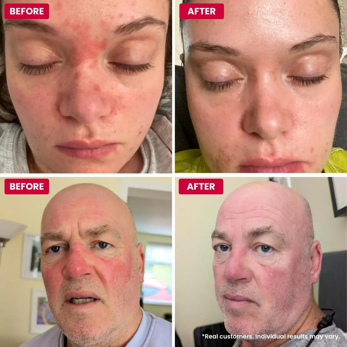 Grahams Natural Rosacea Treatment for Face Redness – Clinically Proven Anti Redness Moisturizer, Soothes & Reduces Flare Ups, Hypoallergenic & Steroid-Free (2.64 oz) Avelisse